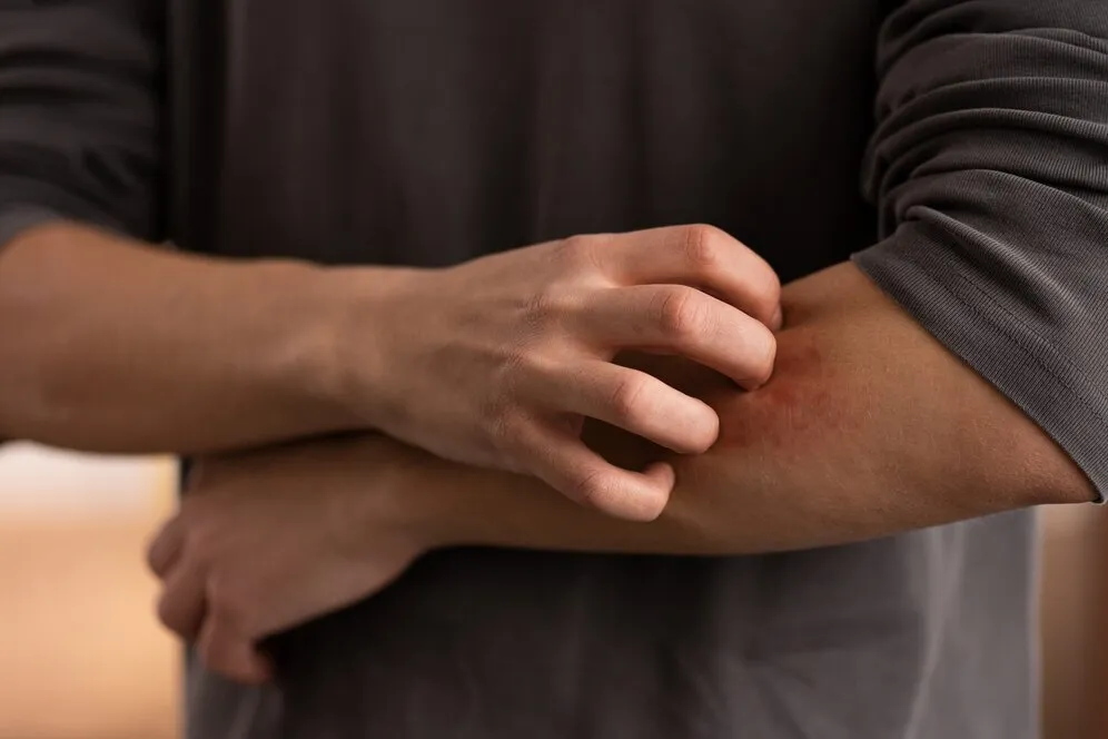 Bites and Stings
